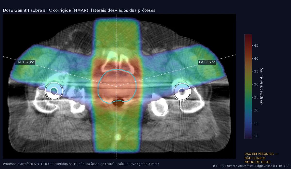 Dose em cores sobre o corte axial de pelve com quatro campos; os laterais a 75° e 285° passam acima das próteses.