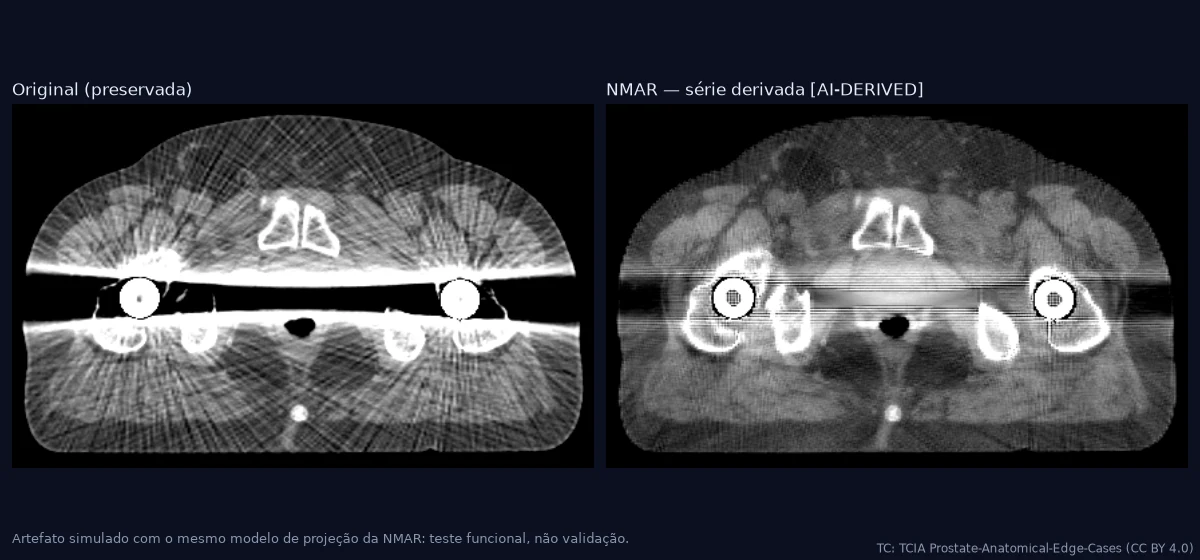 Mesmo corte axial de pelve antes e depois da correção NMAR, com as estrias reduzidas na imagem corrigida.