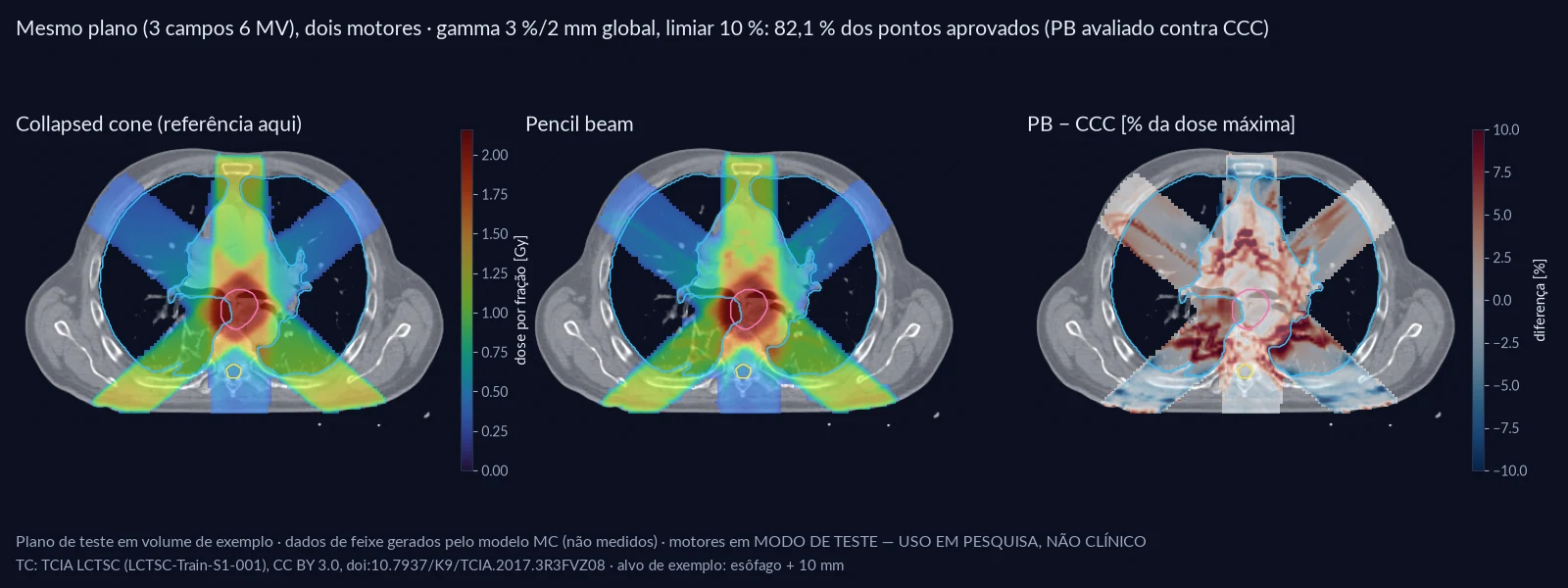 Corte axial de TC de tórax com a dose de um plano de três campos calculada por collapsed cone, por pencil beam e o mapa da diferença entre os dois