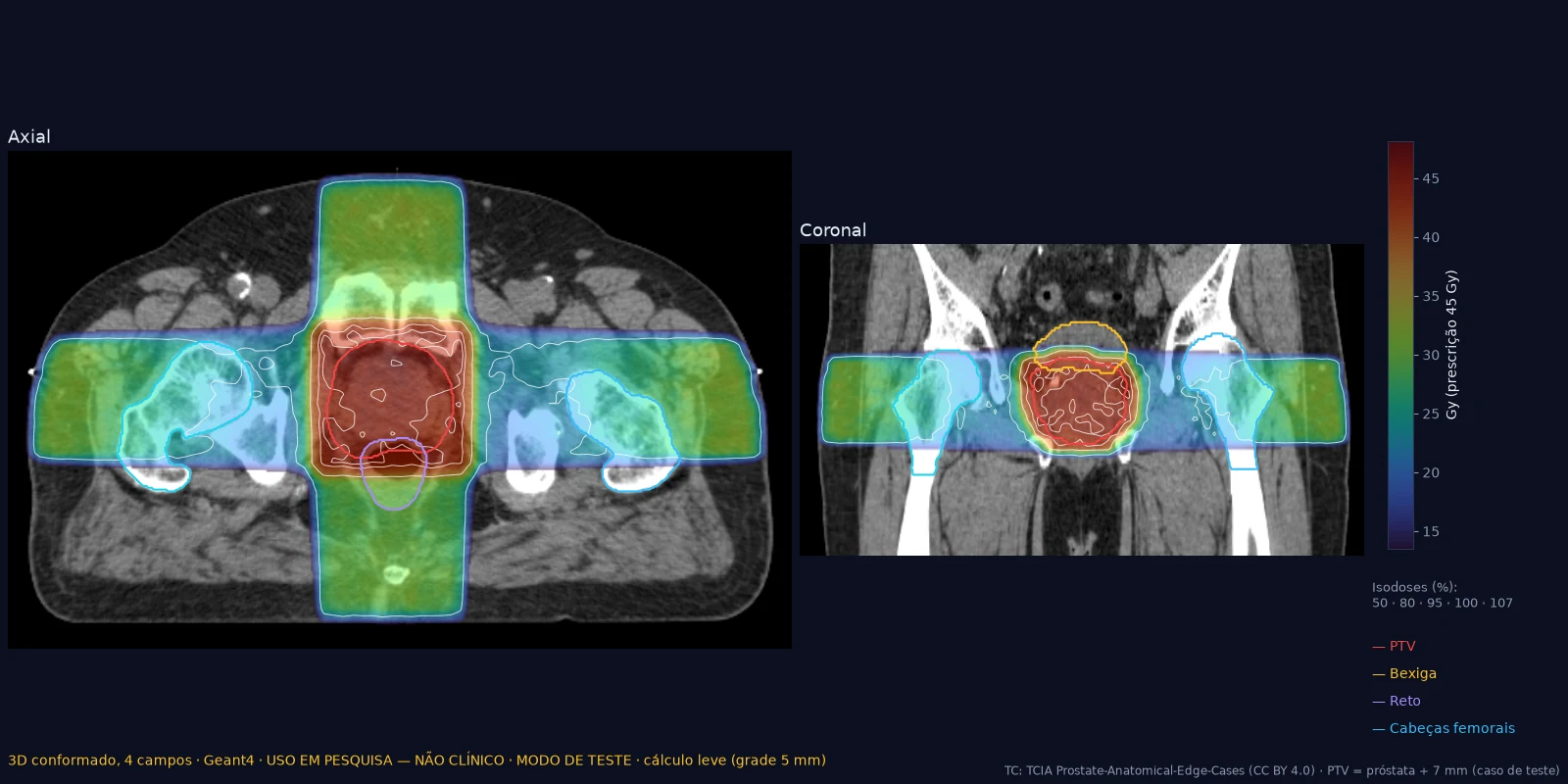 Cortes axial e coronal de TC de pelve com a distribuição de dose de um plano 3D de quatro campos em cores, isodoses e os contornos do PTV, da bexiga, do reto e das cabeças femorais.